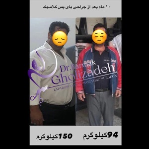 جراحی-چاقی-03