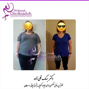جراحی-چاقی-05