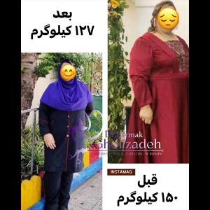 جراحی-چاقی-10