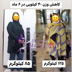 جراحی-چاقی-11