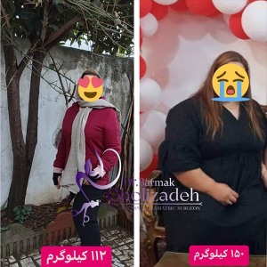 جراحی-چاقی-12