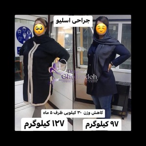 جراحی-چاقی-13