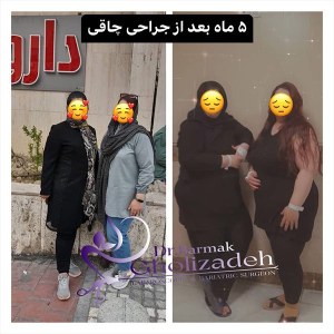 جراحی-چاقی-16