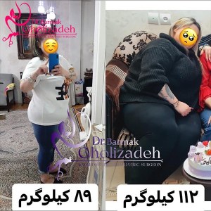 جراحی-چاقی-17