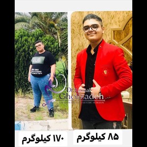 جراحی-چاقی-18