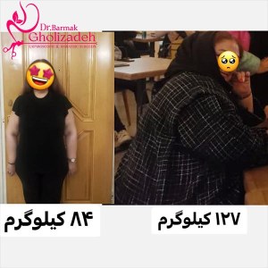 جراحی-چاقی-19