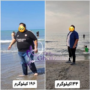 جراحی-چاقی-20
