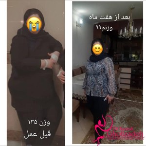 جراحی-چاقی-21