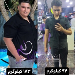جراحی-چاقی-22