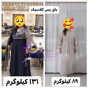 جراحی-چاقی-28