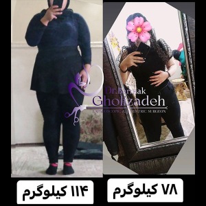 جراحی-چاقی-29