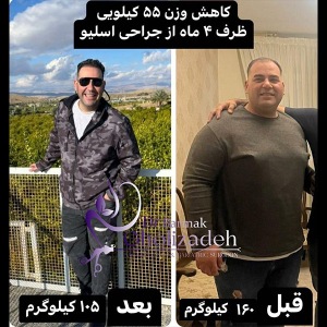 جراحی-چاقی-30