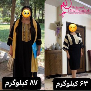 جراحی-چاقی-35