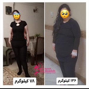 جراحی-چاقی-36