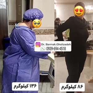 جراحی-چاقی-39