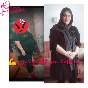 جراحی-چاقی-40