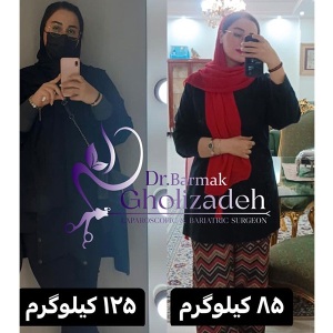 جراحی-چاقی-42