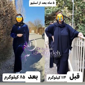 جراحی-چاقی-43