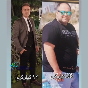 جراحی-چاقی-50