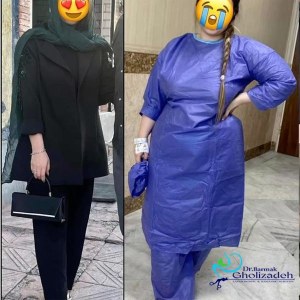 جراحی-چاقی-55
