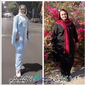 جراحی-چاقی-57