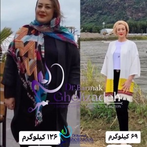جراحی-چاقی-58