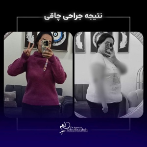 1_Bariatric-Surgery-60