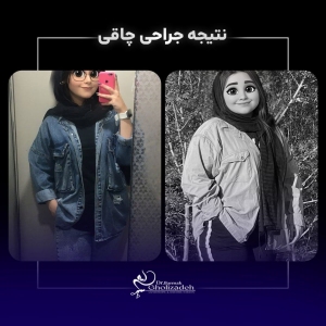 1_Bariatric-Surgery-61