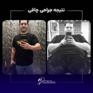 1_Bariatric-Surgery-62