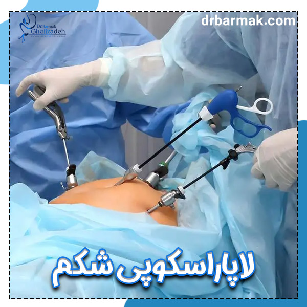 لاپاراسکوپی شکم + دکتر برمک قلی زاده