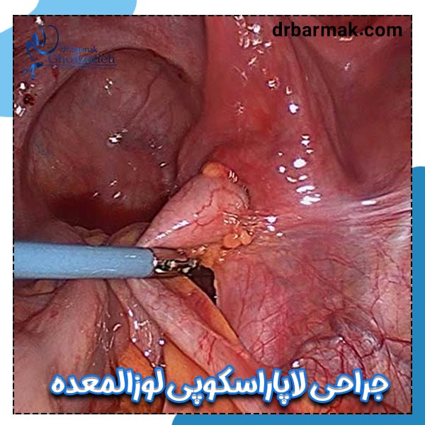 جراحی لاپاراسکوپی لوزالمعده - دکتر برمک قلی زاده