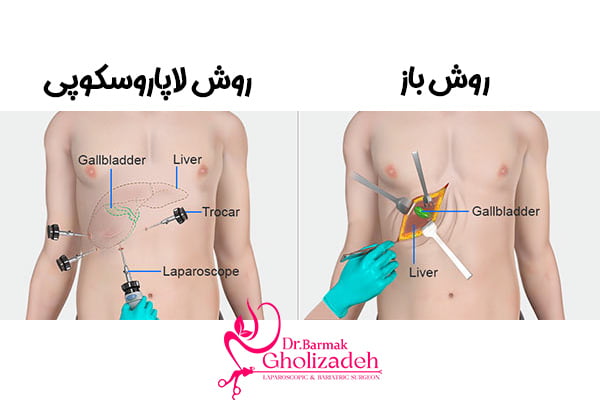 جراحی کیسه صفرا به روش باز و لاپاروسکوپی