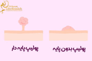 پولیپ پایه ‌دار و بدون پایه