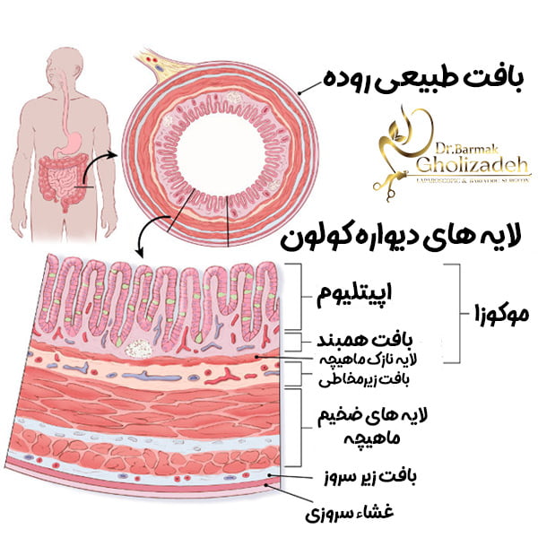بافت-سرطان-کلون