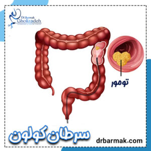 سرطان کولون - دکتر برمک قلی زاده