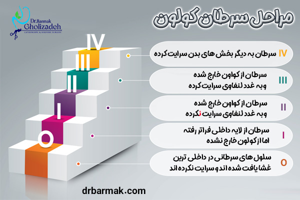 مراحل سرطان کولون 