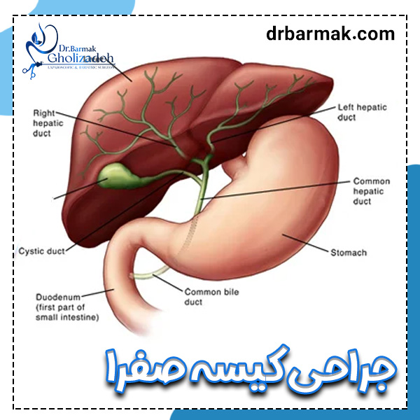جراحی کیسه صفرا - دکتر برمک قلی زاده