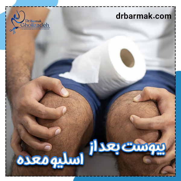 یبوست بعد از اسلیو معده + دکتر برمک قلی زاده