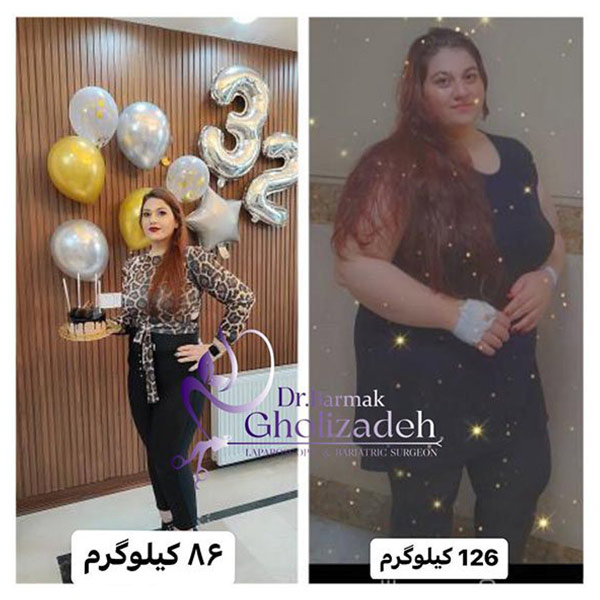 عکس قبل و بعد از اسلیو معده - دکتر برمک قلی زاده 