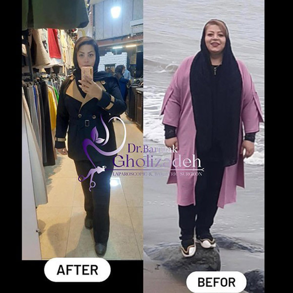 تصاویر قبل و بعد از اسلیو معده - دکتر برمک قلی زاده 