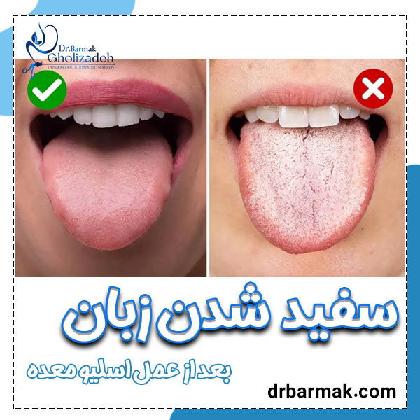 سفید شدن زبان بعد از اسلیو معده - دکتر قلی زاده