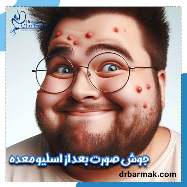 جوش بعد از اسلیو معده - دکتر برمک قلی زاده