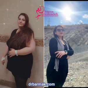تصاویر رضایت از دکتر برمک قلی زاده - بهترین جراح چاقی