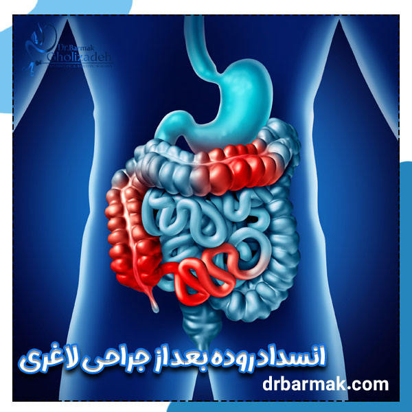 انسداد روده بعد از جراحی لاغری - دکتر قلی زاده 