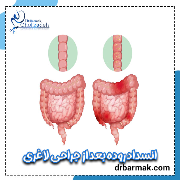 انسداد روده بعد از جراحی لاغری - دکتر قلی زاده 