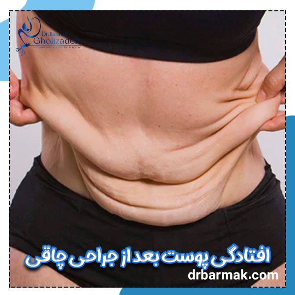 افتادگی پوست بعد از جراحی چاقی - دکتر برمک قلی زاده