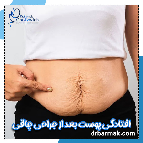 افتادگی پوست بعد از جراحی چاقی - دکتر برمک قلی زاده