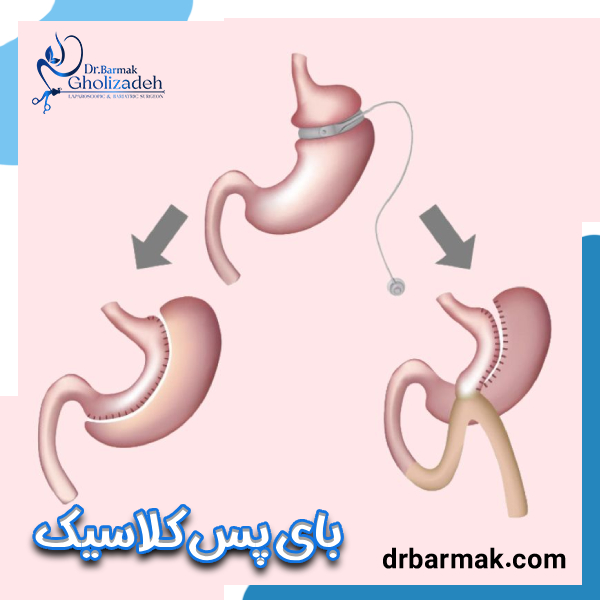 عمل مجدد اسلیو معده - دکتر برمک قلی زاده