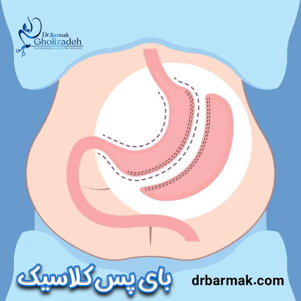 عمل مجدد اسلیو معده - دکتر برمک قلی زاده