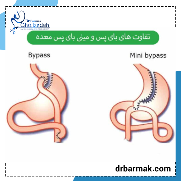 مینی بای پس معده - دکتر قلی زاده